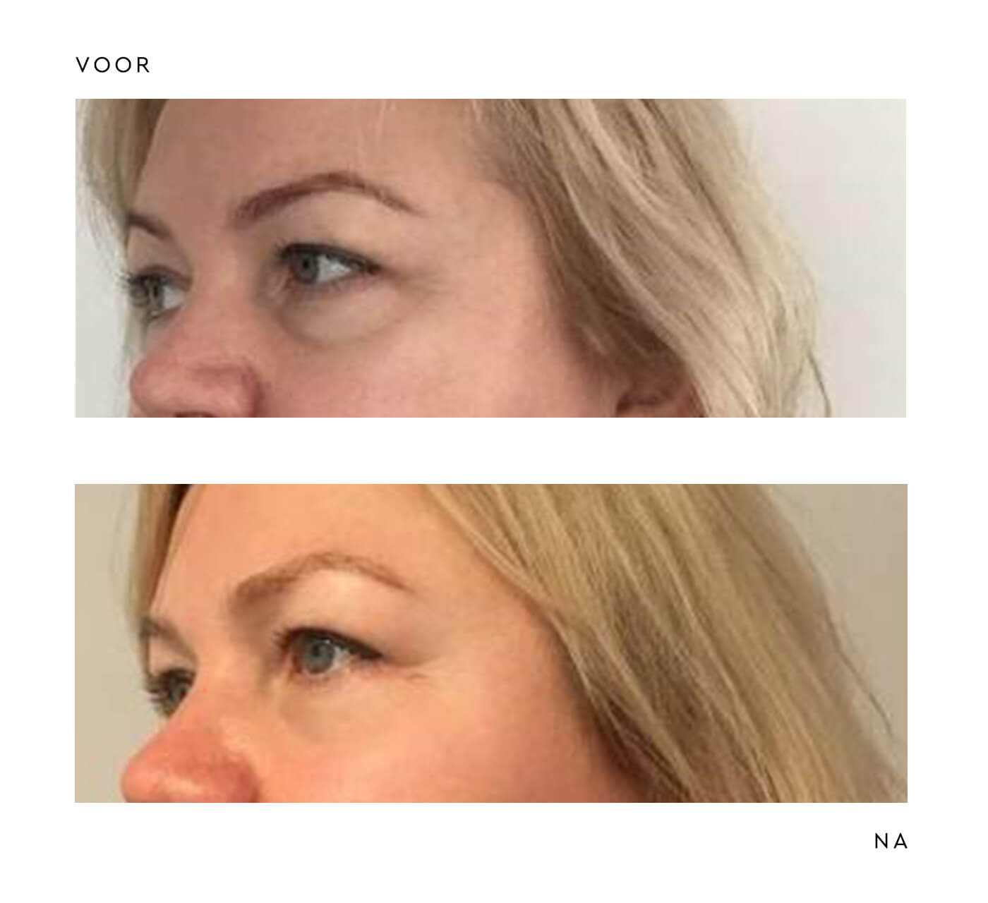 Onderste ooglidcorrectie